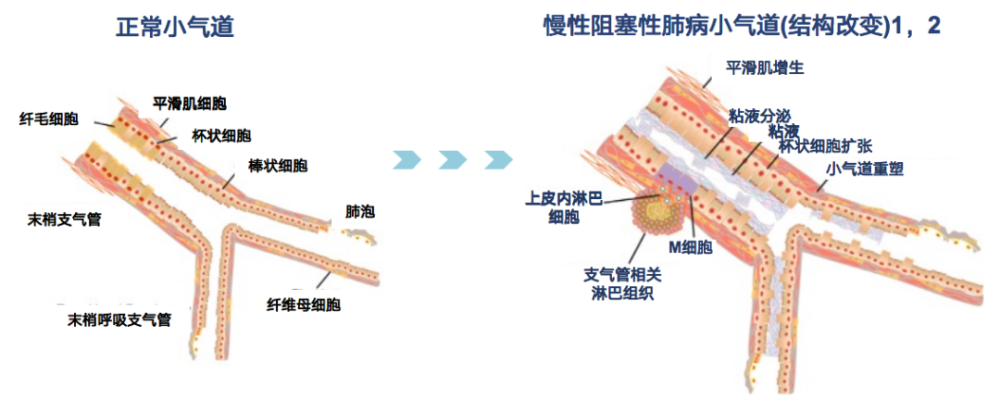 郭岩斐教授关于慢阻肺小气道病变的研究进展检测方法及治疗方案