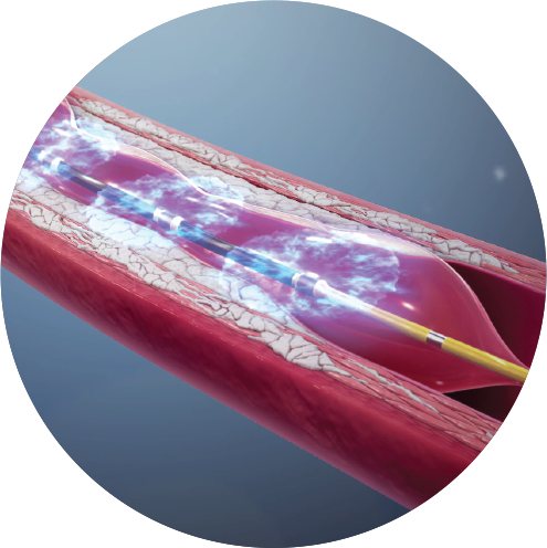 国内首例冠脉冲击波手术成功实施