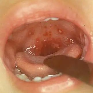 疱疹性咽峡炎家长药知道
