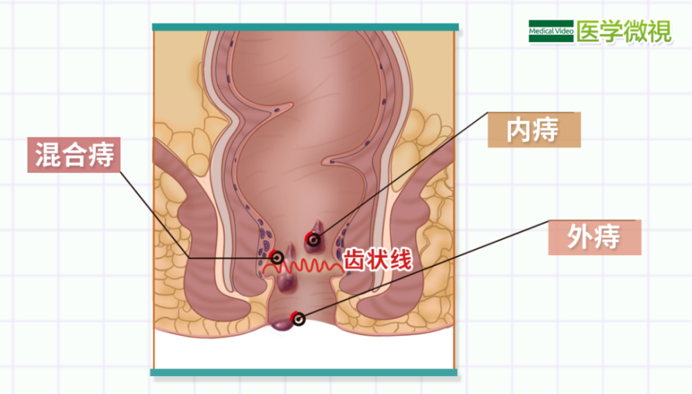 痔疮治不好3个原则5种方法一次给你讲明白