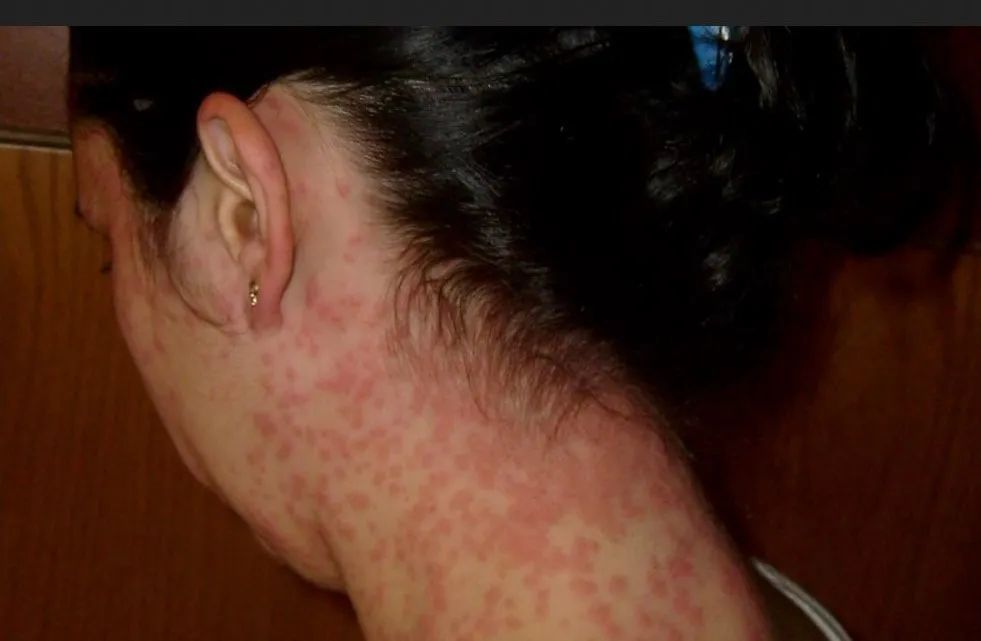 人摸一下就可能进急诊的毛毛虫在美国爆发了