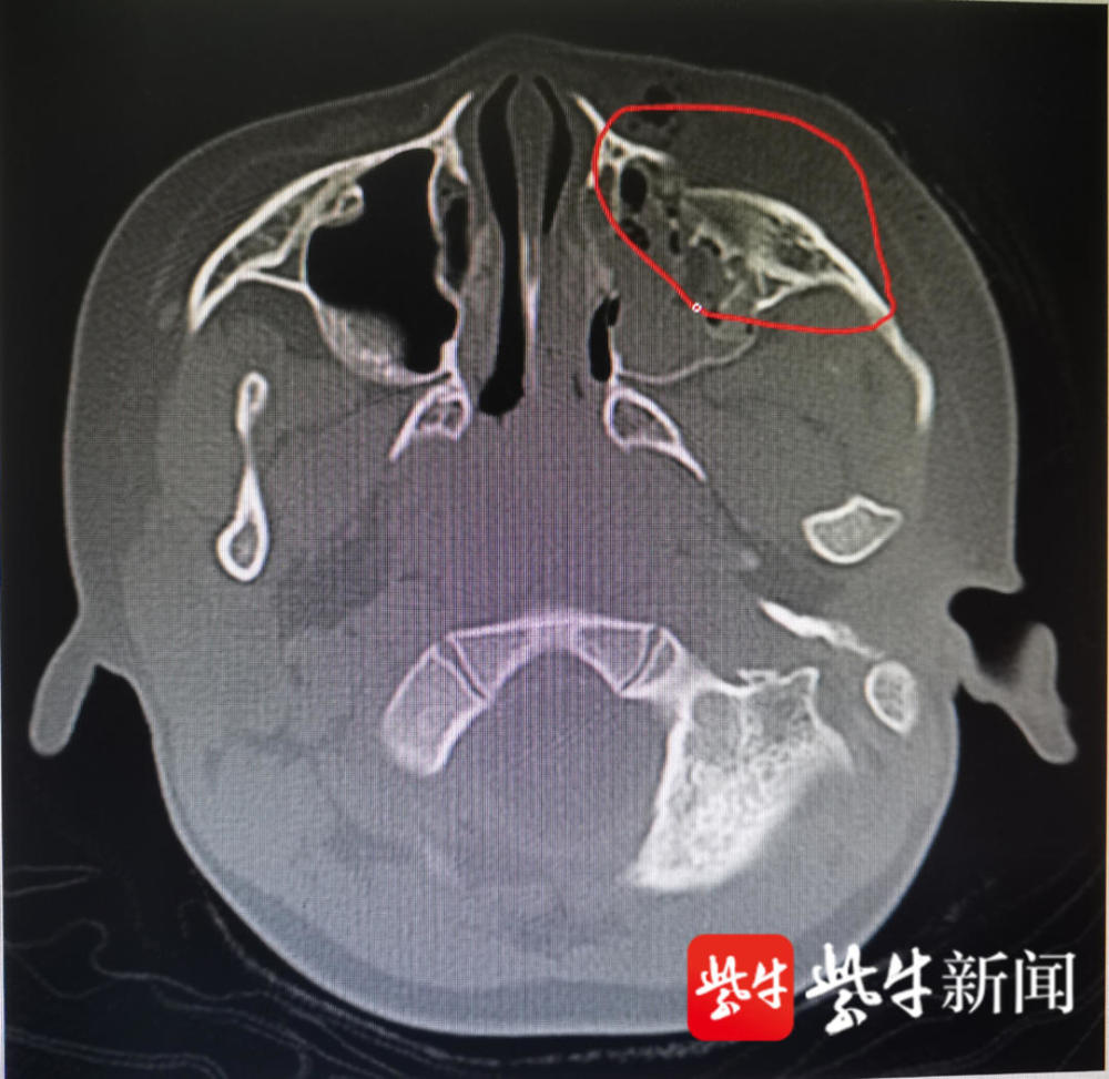 孩子满脸是血,眼眶周围有严重的撕裂伤,ct检查显示眼眶有多处骨折