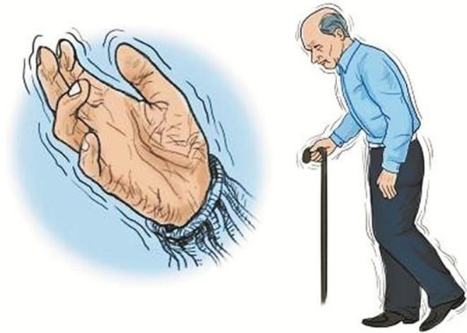 颤抖,流口水?帕金森到底会给患者造成什么伤害?