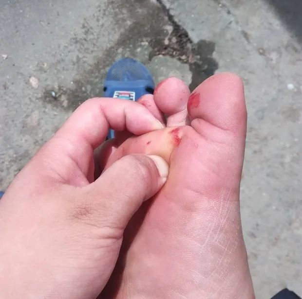 警惕!81岁老大爷无意被扎伤,险些"失足"