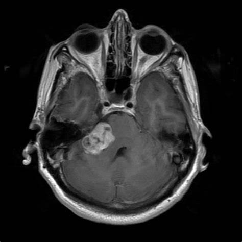 听神经瘤的主要临床表现:5大阶段症状详解