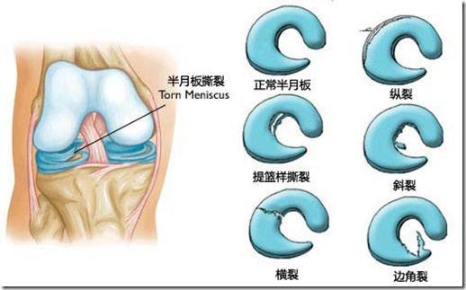 半月板后角撕裂的最好治療方法