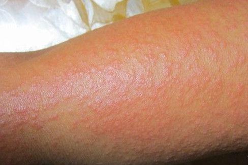 使用这些抗癌药容易出现光敏反应,一定要防晒,否则皮肤长斑起泡!