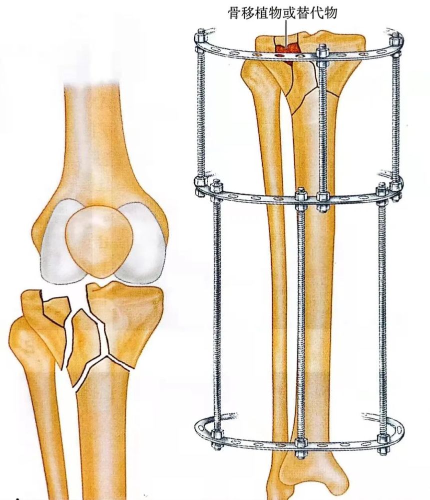 脛骨近端骨折:環形外固定架_騰訊新聞