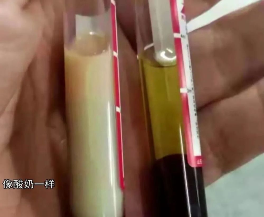 钟水生 仔细查看患者的症状 结合相关病史 认为是长期高血脂症导致