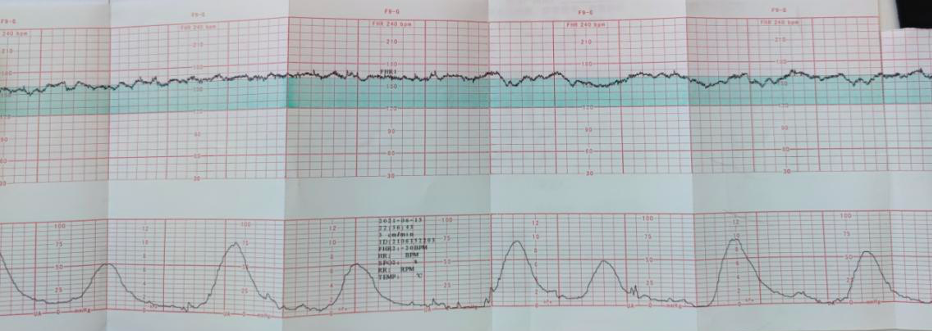 入院电子胎心监护如图 1:产科彩超:bpd 95 mm,ac 327 mm,fl 73 mm,afv