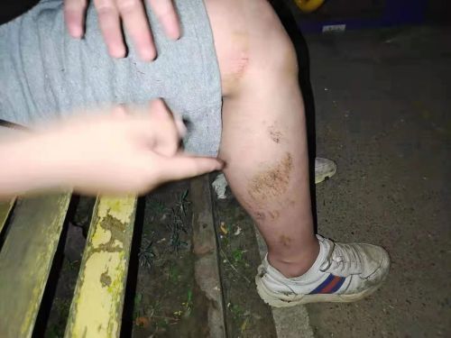 井盖变翻盖沈阳小伙腿卡秃噜皮这事谁负责