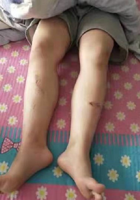 沈阳小伙腿卡秃噜皮,这事谁负责?_腾讯新闻