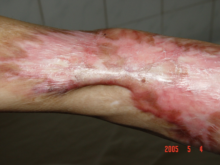 疤痕癌的早期症状图片图片