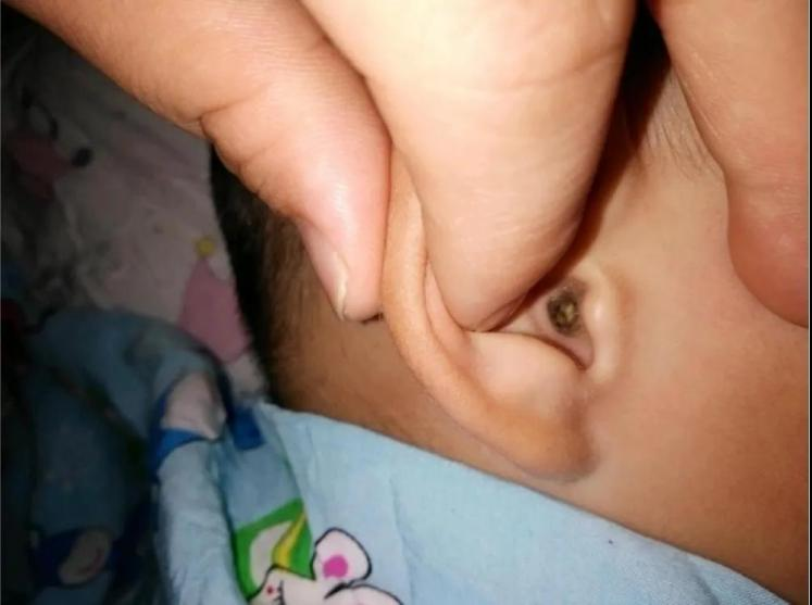 这种耳屎正在毁掉孩子听力一旦发现必须掏快看你家孩子有没有