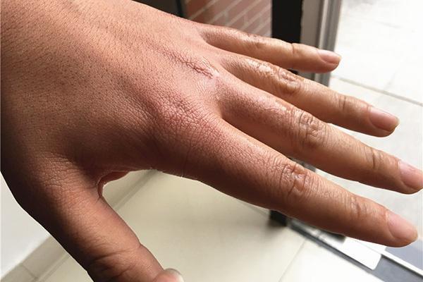 为什么有些人手背上的青筋很粗?有些人却看不到?哪种情况更好?