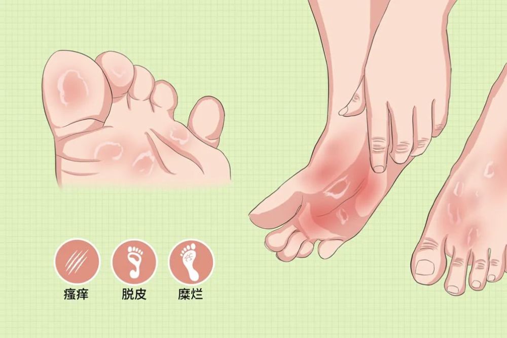 为什么脚气会反复发作呢 反复长脚气是什么原因引起的