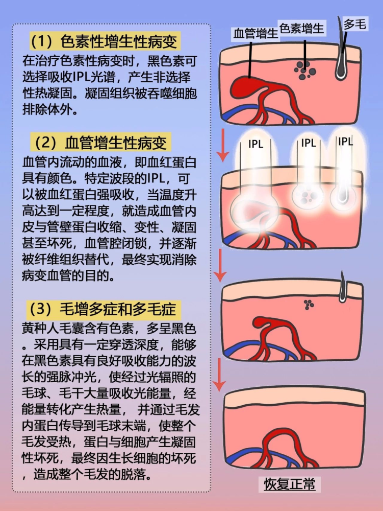 光子嫩肤是什么功效(光子嫩肤是什么功效和作用)