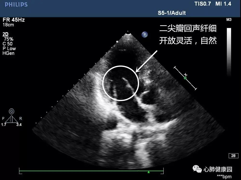 二尖瓣狭窄与二尖瓣关闭不全心脏彩超报告解读