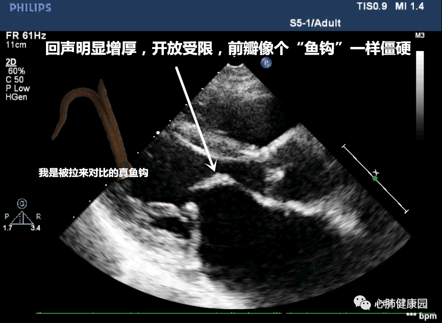 图1(a)二尖瓣回声纤细,开放灵活,自然,图1(b)回声明显增厚,开放受限