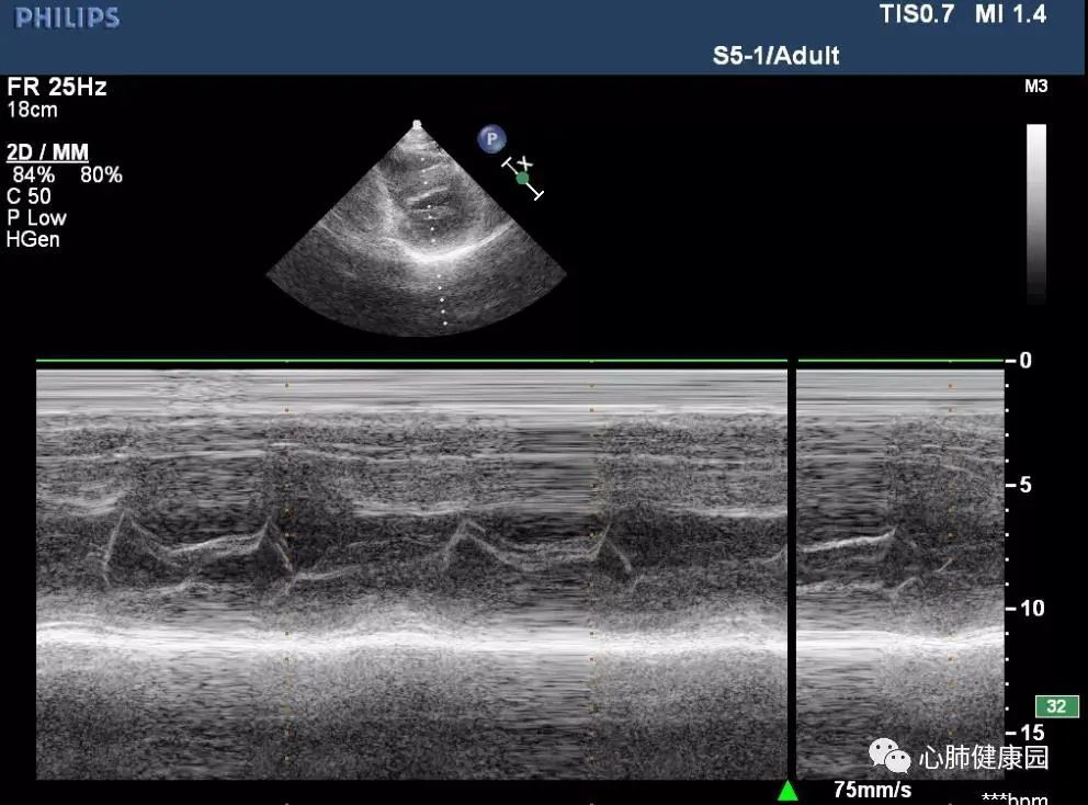 二尖瓣狭窄与二尖瓣关闭不全心脏彩超报告解读
