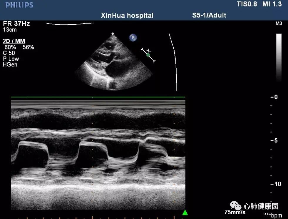 二尖瓣狭窄与二尖瓣关闭不全心脏彩超报告解读