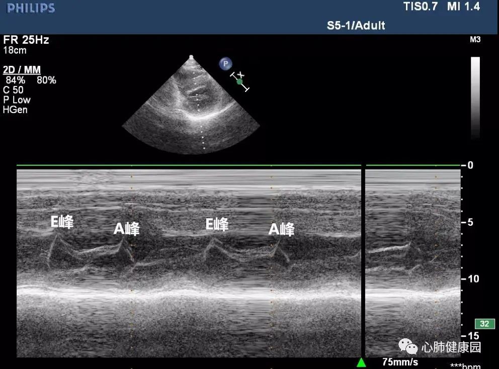 二尖瓣狭窄与二尖瓣关闭不全心脏彩超报告解读