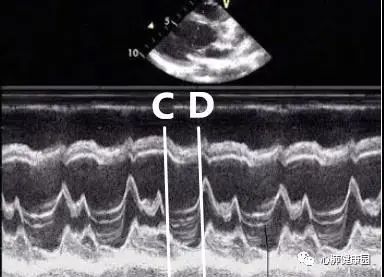 cd段呈吊床樣改變圖4(c)吊床