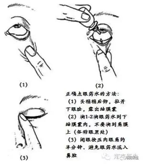 阿托品散瞳的正确图解图片