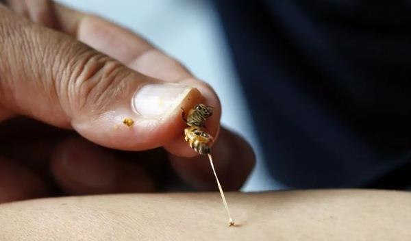 广东一男子洗澡时被马蜂蛰伤,导致休克昏迷,被马蜂蛰伤该怎么办