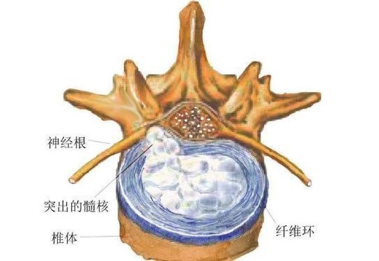 腰椎間盤髓核被纖維環包繞,並無直接血供,其營養來源於軟骨終板和纖維