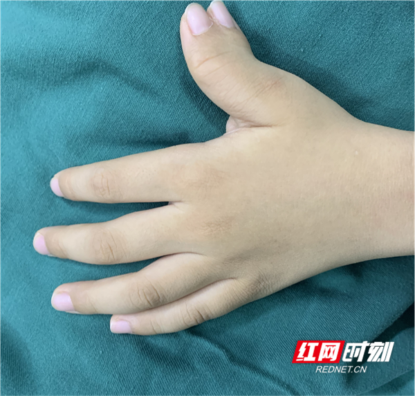 多指不是聪明指别给孩子徒增童年烦恼