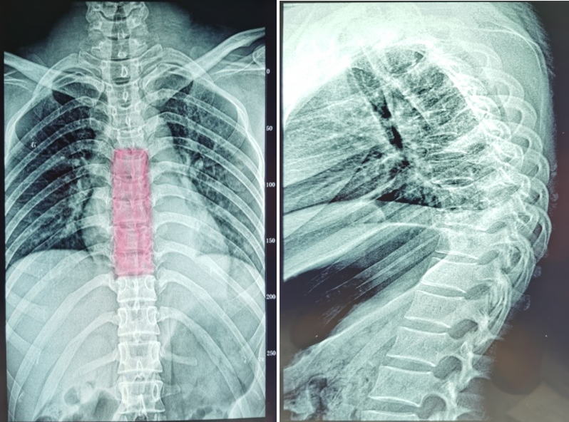 胸椎正侧位x线:提示胸8,9骨折脱位,胸5,6,7椎体骨折