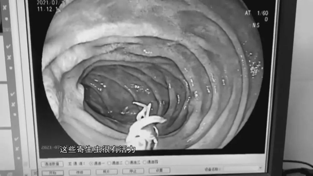 男子腹痛难忍夹出8条活虫医生提醒和这些饮食有关