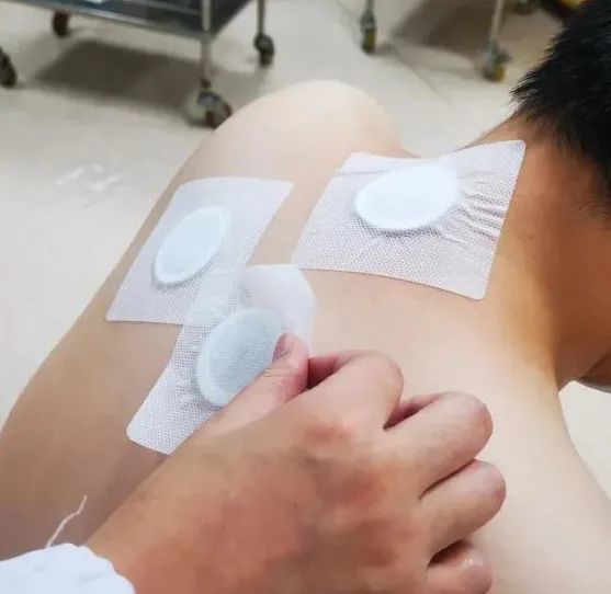 注意三伏膏这么贴易受伤杭州69岁阿姨后背红肿走路都痛