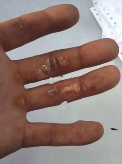 二驴夫妇真摊上事了,售卖的山寨机发生爆炸,炸伤消费者左手