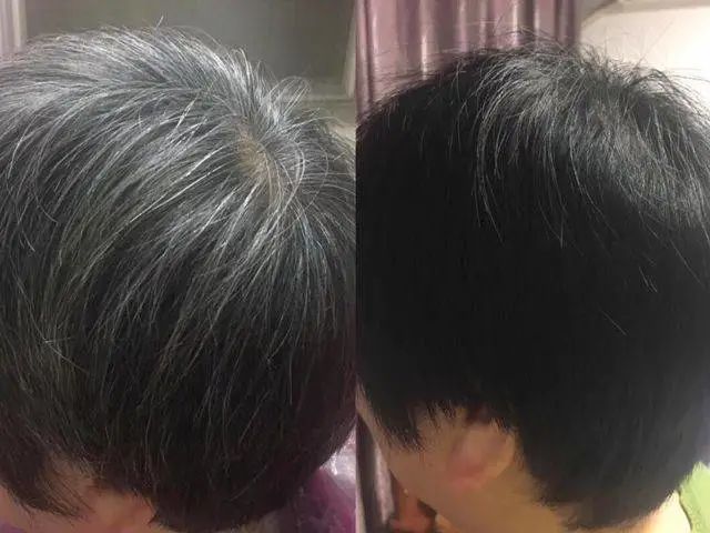 洗一次黑一次,30天白发黑如墨?头发越洗越多,秃了的顶又重新回来了!