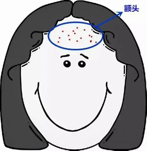 额头长痘痘是什么原因引起的,额头长痘痘如何消除?_腾讯新闻