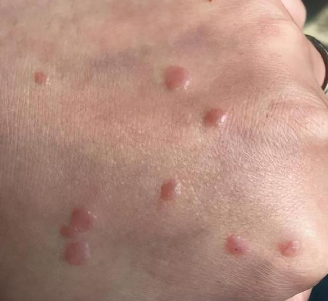 扁平疣能自己消失吗促进扁平疣消失的方法