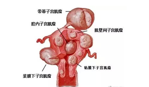 上海濟德正興中醫什麼是子宮肌瘤子宮肌瘤要不要切呢