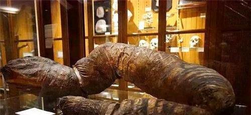 他是唯一被憋死的人,3年没排便,尸检时臭气熏天肠内大便重36斤
