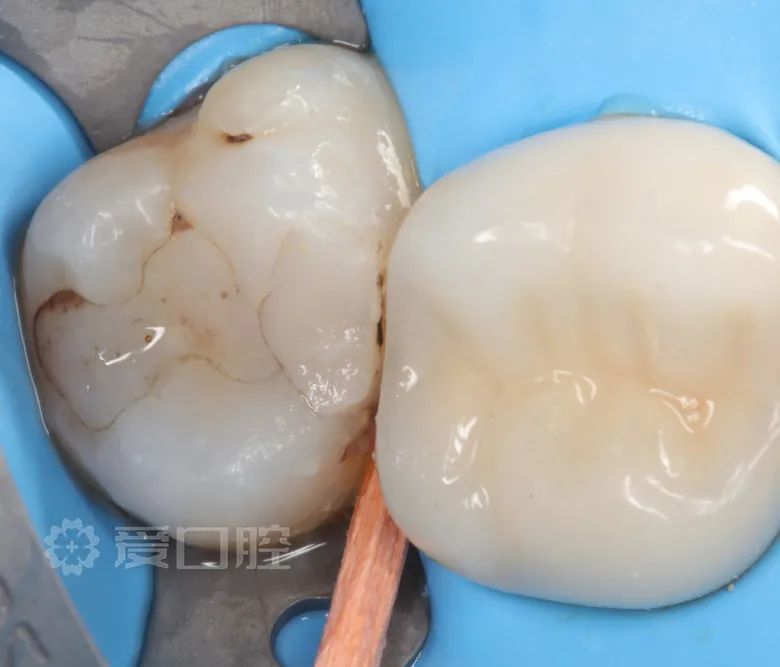 上颌第二磨牙继发龋树脂直接修复1例