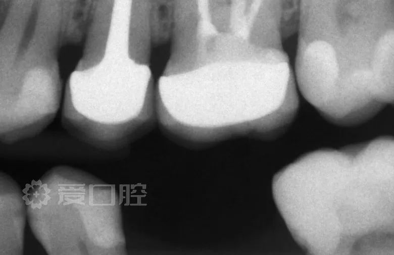 上颌第二磨牙继发龋树脂直接修复1例