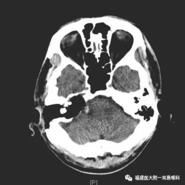 小心长期中耳炎可致胆脂瘤