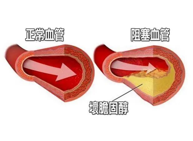 出现这4个症状,血管可能堵塞了!赶快自查