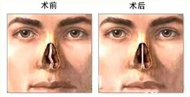 一定要警惕鼻中隔偏曲!