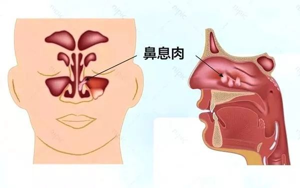 鼻息肉到底是怎么回事