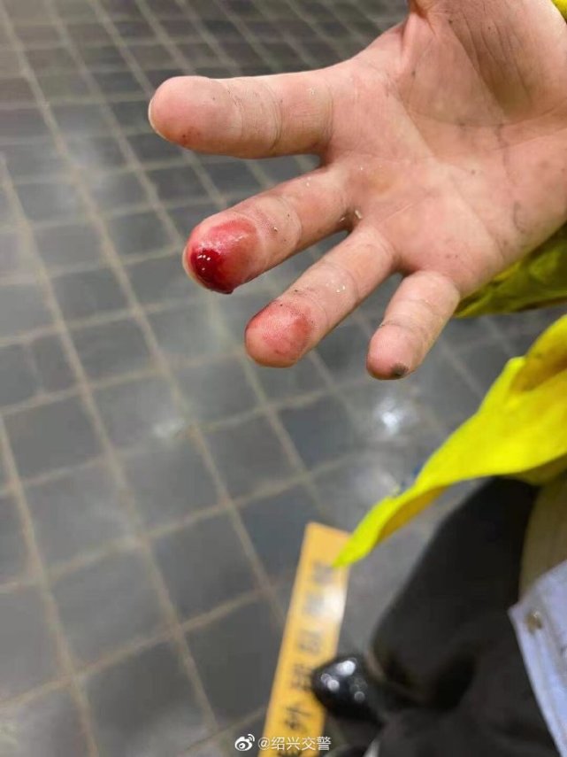 大队巡逻警力发现后,立即对隔离栏进行扶正,期间辅警徐一丰不慎被划伤