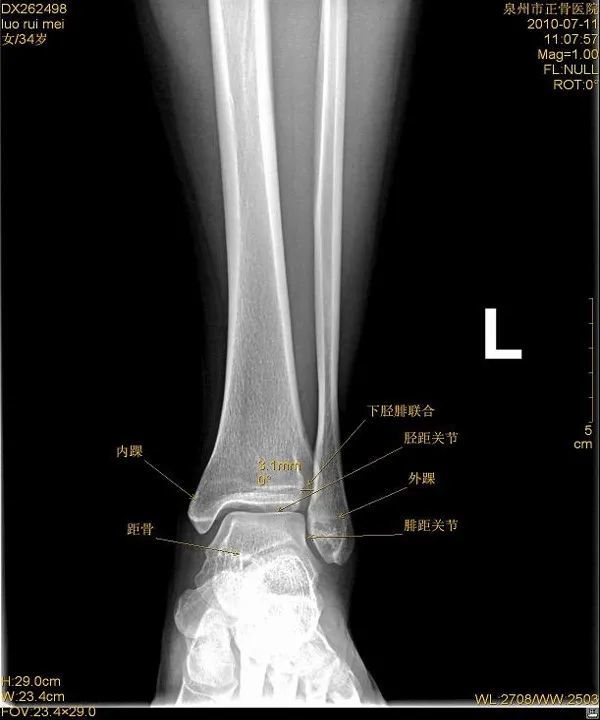 可檢查肌腱,韌帶的損傷ct:能進一步檢查隱匿性骨折或撕脫性骨折x線片