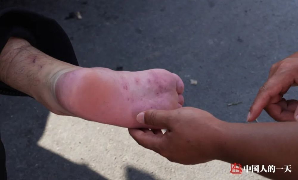 一名队员脚底板溃烂,被队长李延照要求休整治疗,"恢复最好的状态才能