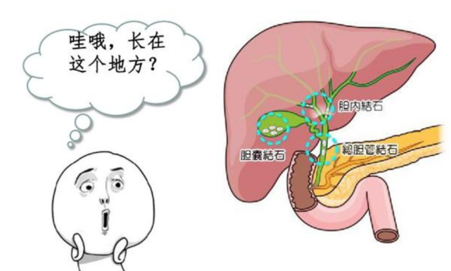 膽結石最怕這幾個習慣,別再做了,傷膽又傷身|膽汁|肝臟|膽結石|膽囊